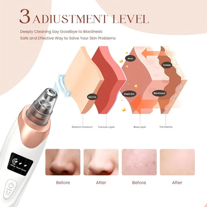Electric Pore Cleaner & Blackhead Remover